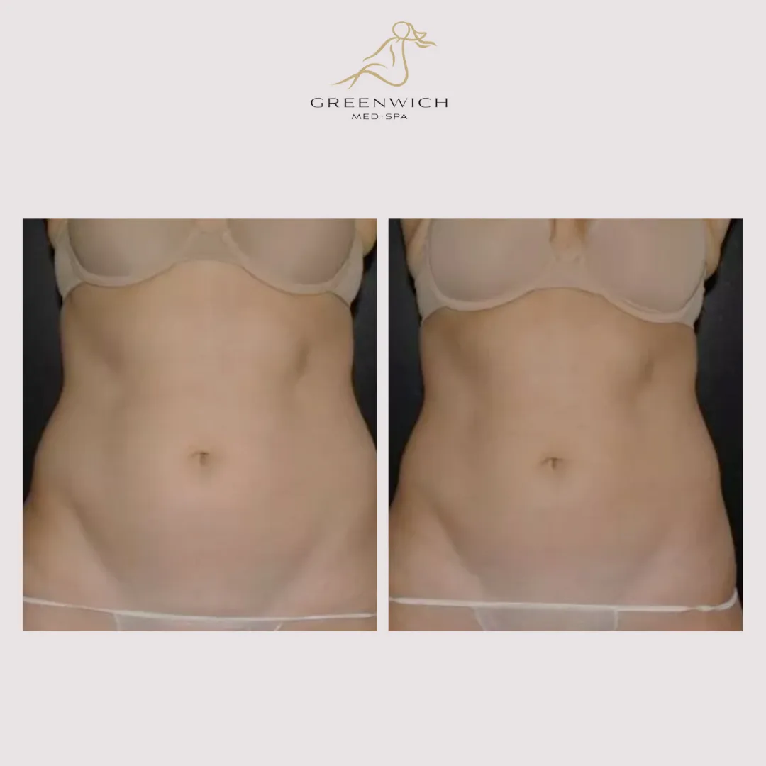 Coolsculpting Before & After Treatment on Abdomen.