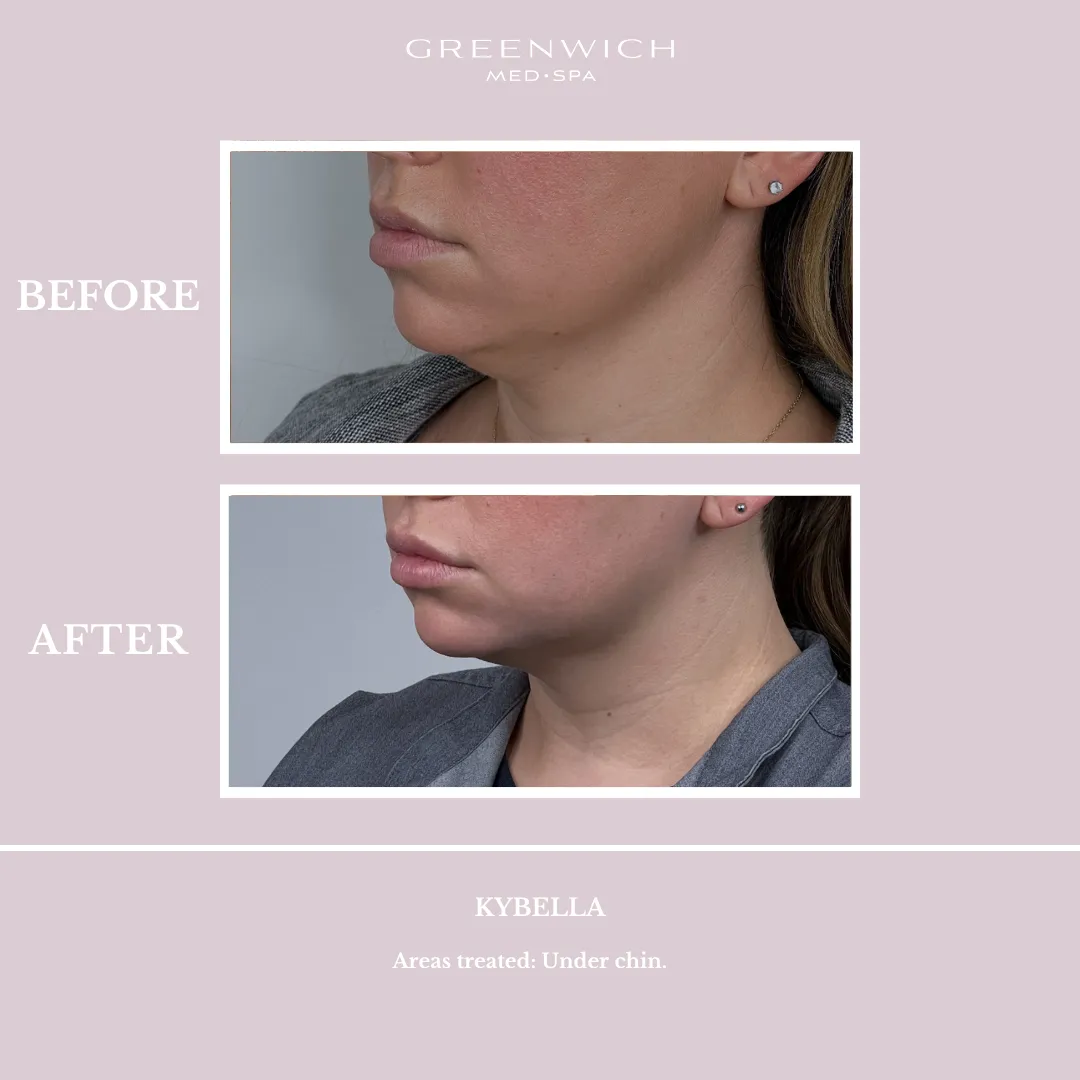 Kybella Gallery Greenwich Medical Spa