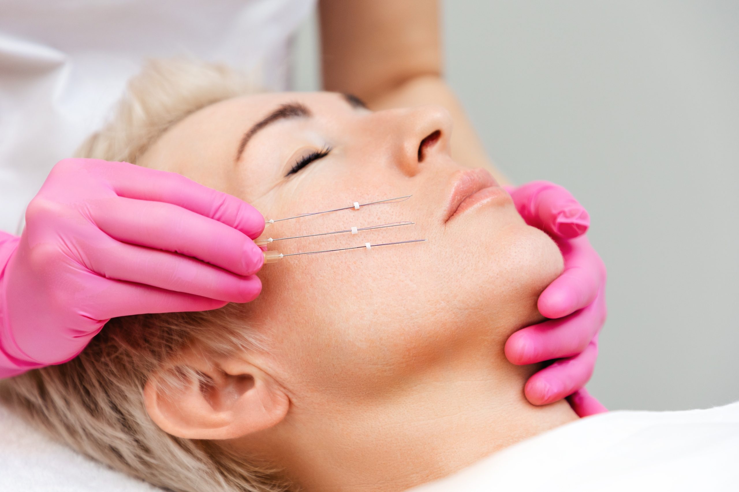 Don't Believe the Hype About PDO Thread Lifts - Greenwich Medical Spa