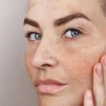 Close-up of a woman with visible sun spots and uneven skin tone, illustrating sun damage treatment, brown spot treatment, and skin rejuvenation options at Greenwich Medical Spa.